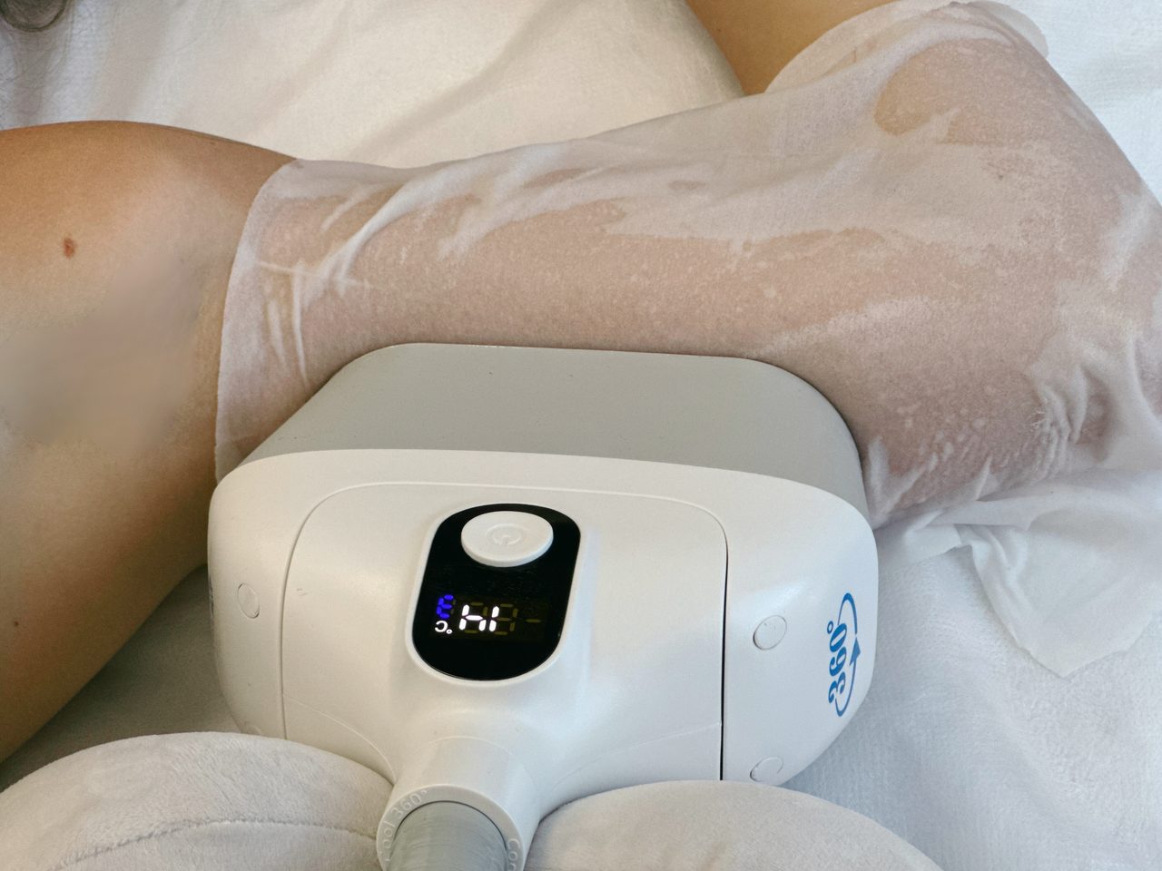 Applicateur cryolipolyse 360° Activ Ice sur cuisse avec affichage température