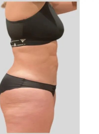 Cryolipolyse abdomen apres Activ Ice