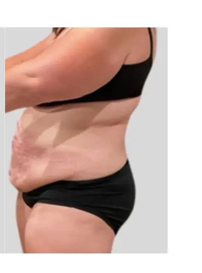 Cryolipolyse abdomen apres Activ Ice
