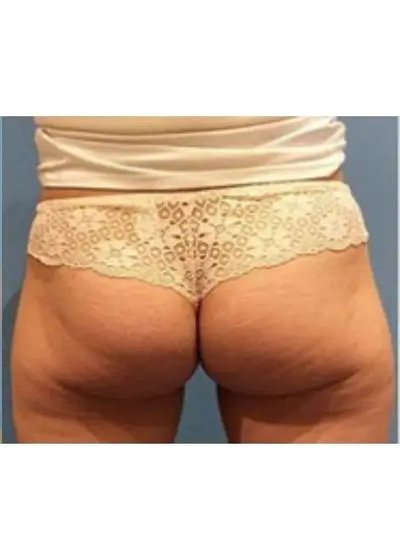 Apres cryolipolyse abdomen Activ Ice