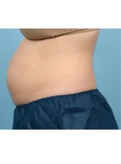 Cryolipolyse abdomen avant Activ Ice