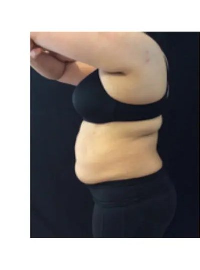 Avant cryolipolyse abdomen Activ Ice