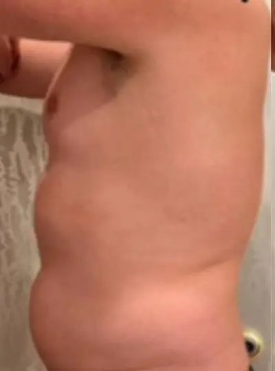 Avant cryolipolyse abdomen Activ Ice