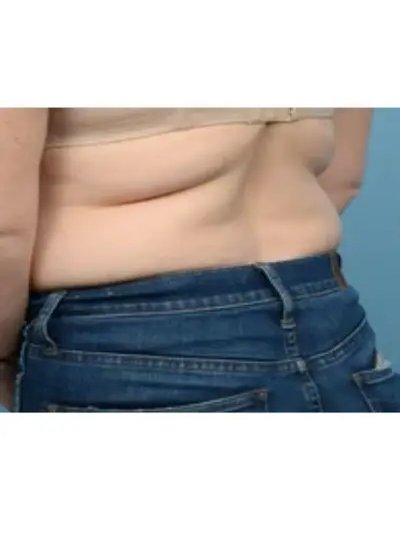 Avant cryolipolyse abdomen Activ Ice