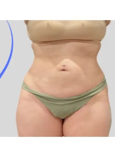 Cryolipolyse cuisses-fesses apres Activ Ice