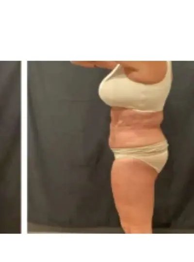 Cryolipolyse flancs apres Activ Ice